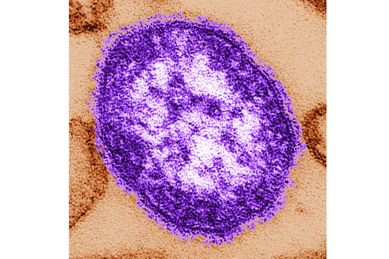 Electron microscope view of a measles virus particle show a purple, circular image.