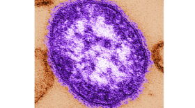 Pennsylvania says an unvaccinated woman has died from measles-related complications