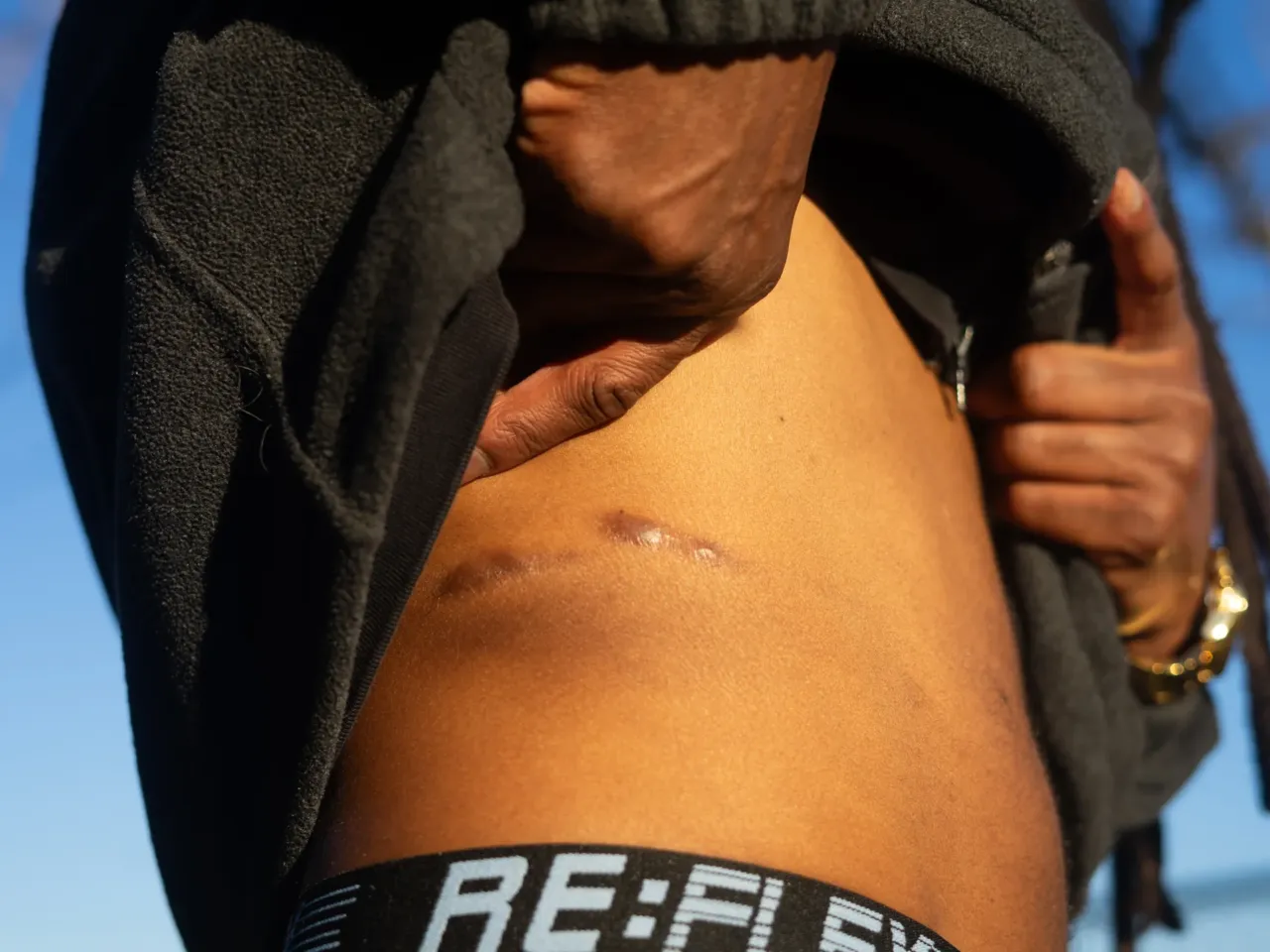 McNair bears scars on his stomach that he says are the result of harsh restraints used on him at USP Lee. He was shackled for roughly 17 hours, he said in a lawsuit.